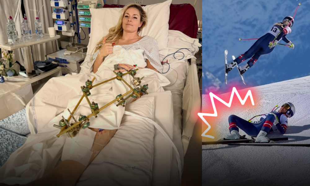 Terzo intervento per Lindsey Vonn: aggiornamento dall’ospedale dopo il terribile infortunio alle Olimpiadi