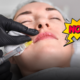 Filler labbra, quando è il momento di rimuoverli